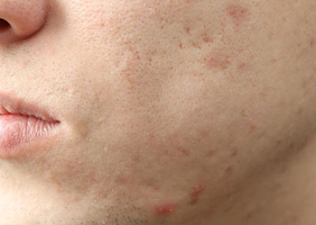 All you need to know about acne pits